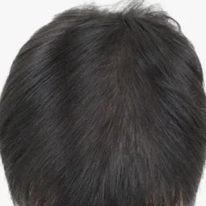 前頭部6000毛 AFTER