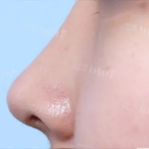 鼻プロテーゼ+鼻中隔延長 AFTER