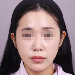 頬骨縮小+エラ削り+顎削り AFTER