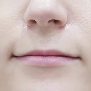 唇フィラー BEFORE