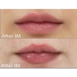 AI フィラー(唇) AFTER