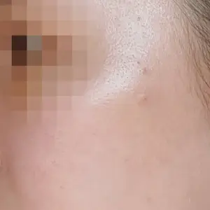 スキンブースター AFTER