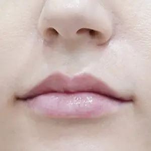 唇フィラー AFTER