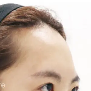 AI フィラー（額） BEFORE