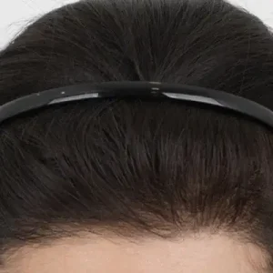 ヘアライン2500毛 AFTER