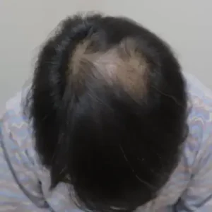 女性頭頂部 BEFORE