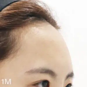 AI フィラー（額） AFTER