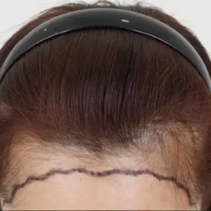 ヘアライン2500毛 BEFORE