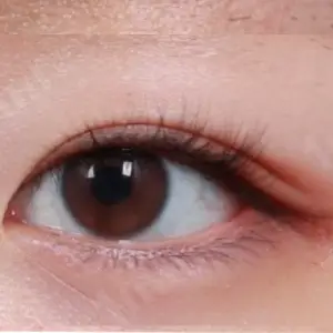 切開目つき矯正（他院修正） AFTER