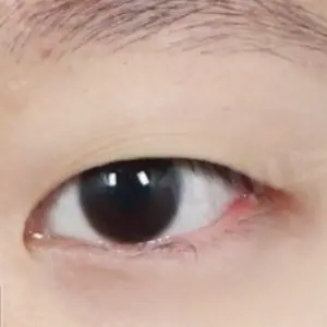 二重切開+目上切開 BEFORE