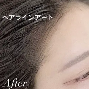 ヘアラインアートメイク AFTER