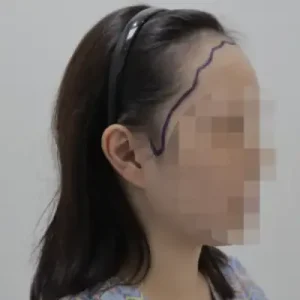 女性生え際 BEFORE