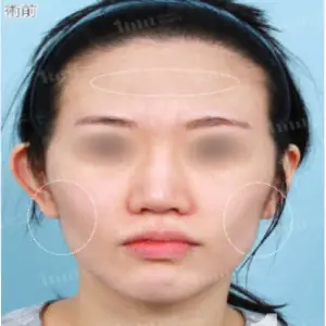 顔の脂肪移植 BEFORE