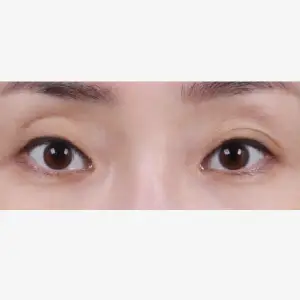 自然癒着法 BEFORE