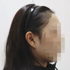 女性生え際 AFTER