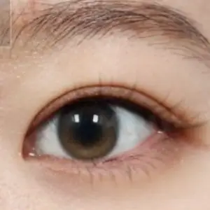 二重切開+目上切開 AFTER