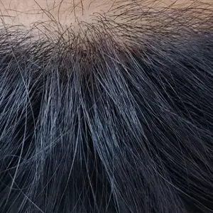 HAIR LINE AFTER