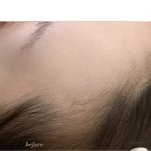 ヘアライン BEFORE