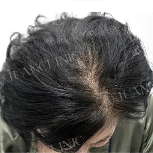 幹細胞治療 BEFORE