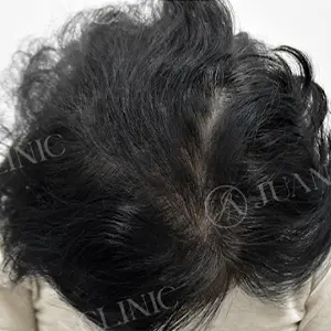 幹細胞治療 AFTER