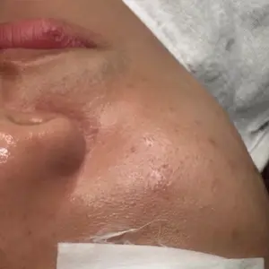 毛穴ケア BEFORE