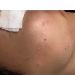 毛穴ケア BEFORE