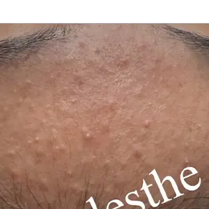 毛穴ケア BEFORE