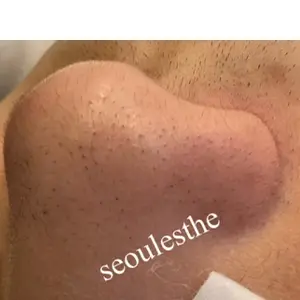 毛穴ケア BEFORE