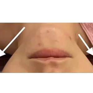小顔ケア AFTER