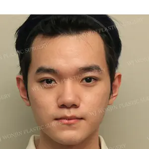 鼻の整形 BEFORE