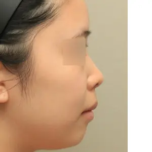 鼻整形＋輪郭手術＋脂肪吸引 BEFORE