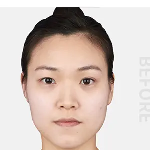 輪郭手術 BEFORE