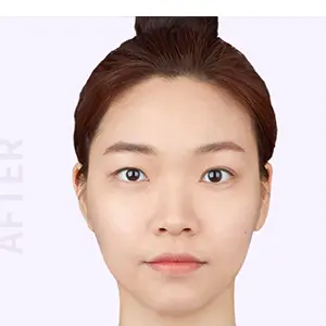 輪郭手術 AFTER