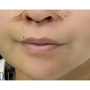 ヒアルロン酸・フィラー施術 BEFORE