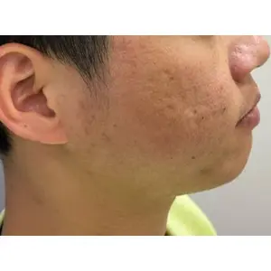 レーザー肌治療 BEFORE