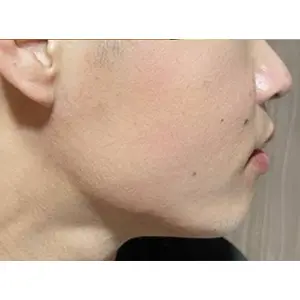 レーザー肌治療 AFTER
