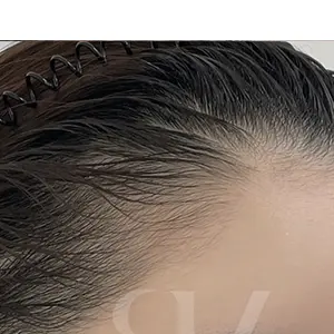 HAIRLINE BEFORE