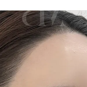 HAIRLINE AFTER