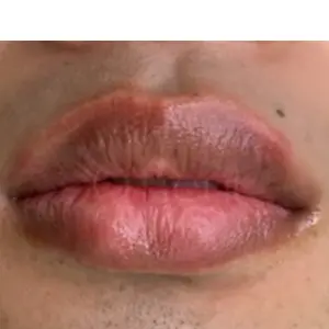 リップのルメラ BEFORE