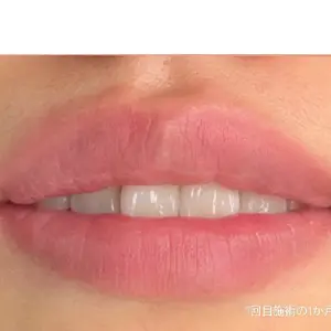 リップリフレッシュ AFTER