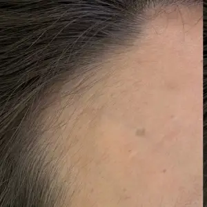 ヘアライン BEFORE