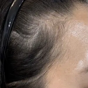 ヘアライン（点） BEFORE