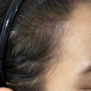 ヘアライン（点） AFTER