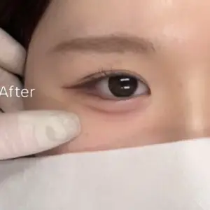 涙袋アートメイク AFTER