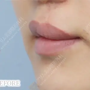 口唇口蓋裂手術 BEFORE