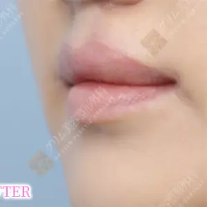 口唇口蓋裂手術 AFTER