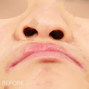 口唇口蓋裂手術　鼻矯正＋唇整形+傷跡修正 BEFORE