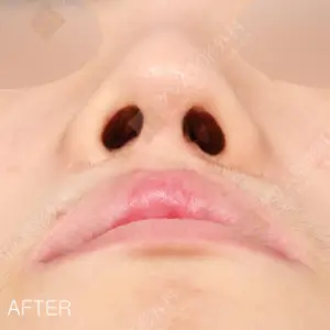 口唇口蓋裂手術　鼻矯正＋唇整形+傷跡修正 AFTER