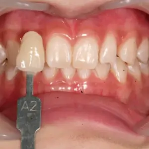 ホワイトニング BEFORE