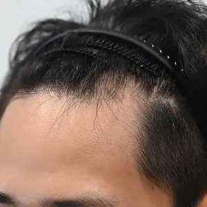 男性非切開（ヒドゥンカット）2,600株 BEFORE